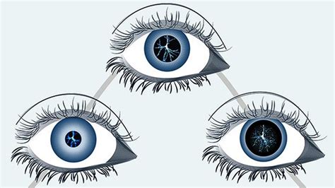 Pupil Size of Eyes Can Predict Death and Hospital Readmission in Heart Failure Patients