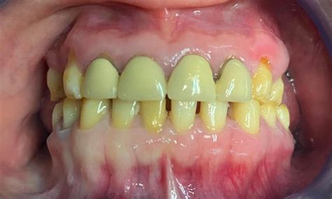 Full Mouth Zirconia Crown And Bridge Work In Lynwood Before And After Photos Los Angeles Ca