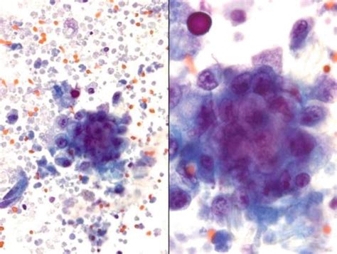 Cerebrospinal Fluid Csf Cytology Springerlink