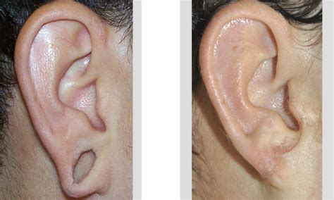 The Energing Trend Of Stretched Gauged Earlobe Repair Explore