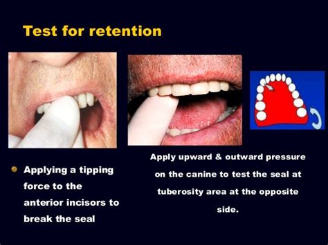 7 Try In Of The Wax Trial Complete Denture