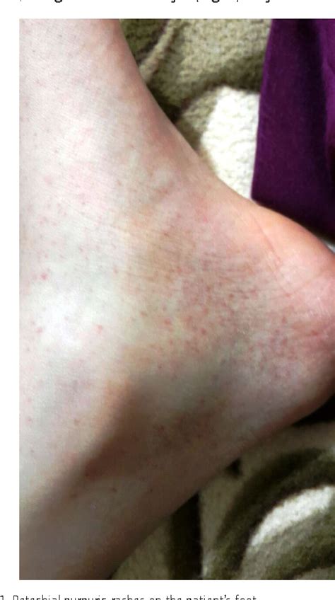 Figure 1 From Petechial Purpuric Rash Leukopenia And Thrombocytopenia