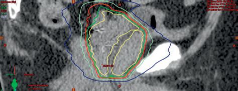 Prostate Sbrt Radiology Key