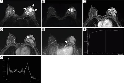 A 44 Year Old Woman With Histologically Proven Plasma Cell Mastitis