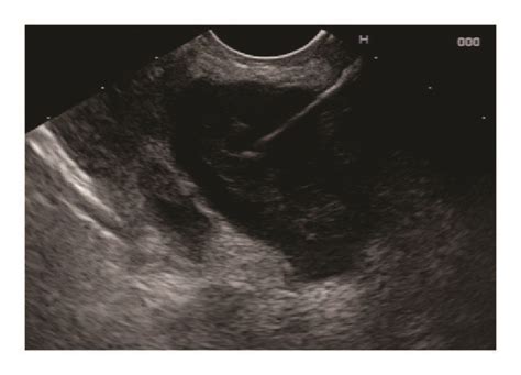 A Endoscopic Ultrasound Eus Demonstrating A 3 Cm Hypoechoic Mass In