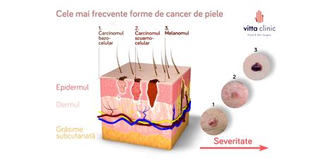 Despre Alunite Nevi I Cancer De Piele Vitta Clinic