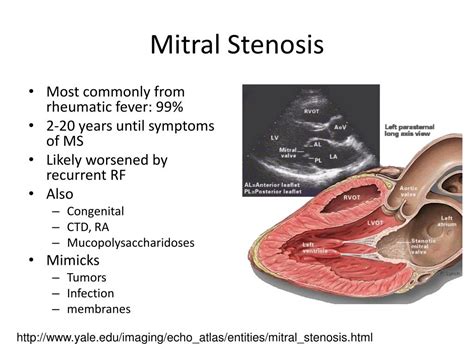 Ppt Valvular Heart Disease The Mitral Valve Powerpoint Presentation