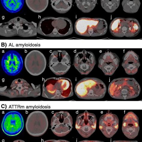 Visualization Of Multiple Organ Amyloid Involvement In Systemic