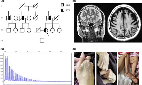 Identification Of Pathogenic C Orf Hexanucleotide Repeat Expansion In