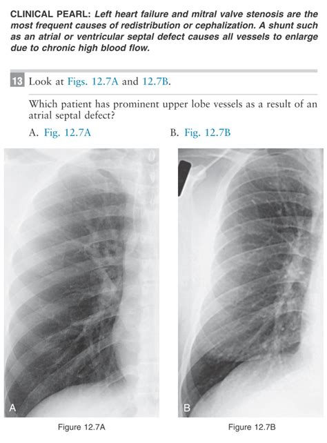 Been Reading Felson S Principles Of Chest Roentgenology Can T Really Get This Question Any