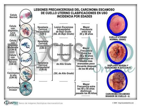 Cáncer De Cervix