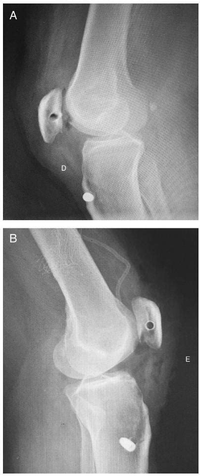 Scielo Brasil Bilateral Atraumatic Patellar Ligament Rupture Case