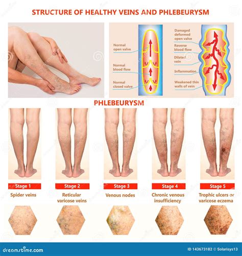 Thrombophlebitis. Deep Vein Thrombosis Stock Photo - Image of female