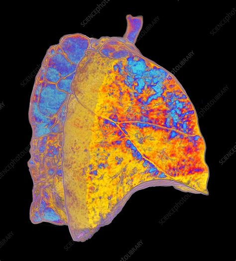 Emphysema lung disease, 3D CT scan - Stock Image - C048/2151 - Science Photo Library