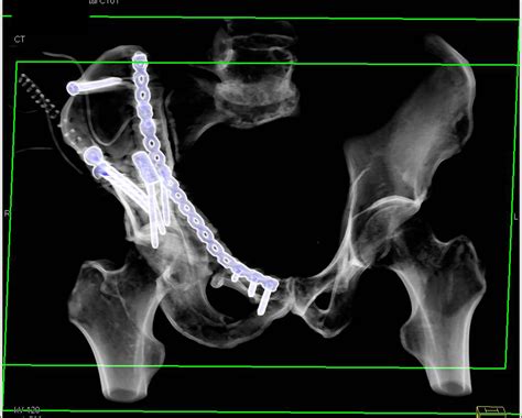 Ct Pelvic Fracture