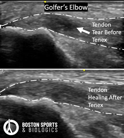 Boston Sports The Role Of Regenerative Medicine In Orthopedics