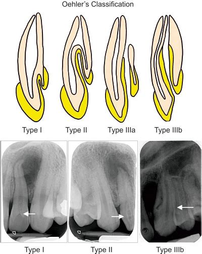 Dens Invaginatus — Kids Dental Tips