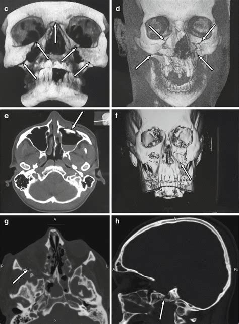 Maxillary Fracture