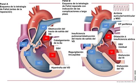 Guía Esc 2020 Para El Tratamiento De Las Cardiopatías Congénitas Del