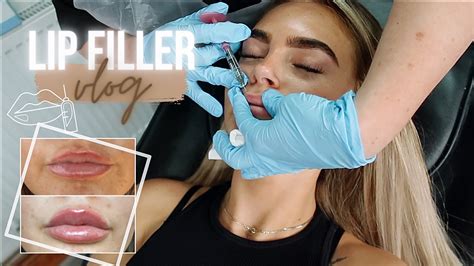 Come With Me To Get Lip Filler Vlog My Lip Filler Experience Youtube