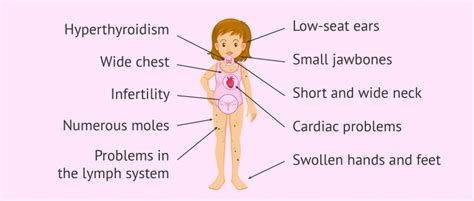 Characteristics Turner syndrome