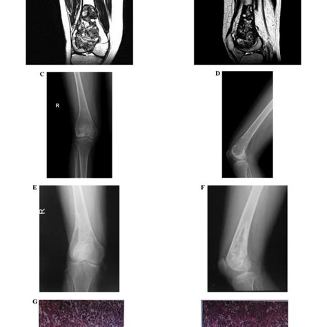 A Year Old Male Complained Of Pain Right Hip And Claudication For