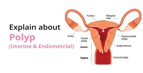 Causes Of Polyps Sessile