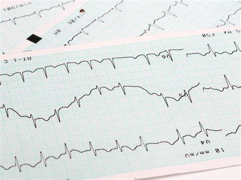 Arritmias Card Acas Dra Alessandra Siqueira Cardiologia Cl Nica