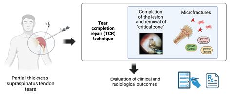 Supraspinatus Tendon Tear Treatment