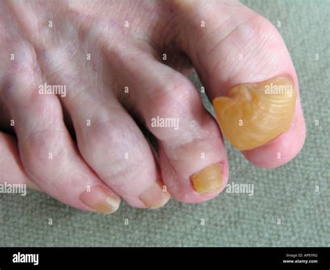 elderly woman's foot showing toes with onychogryphosis a thickening of ...