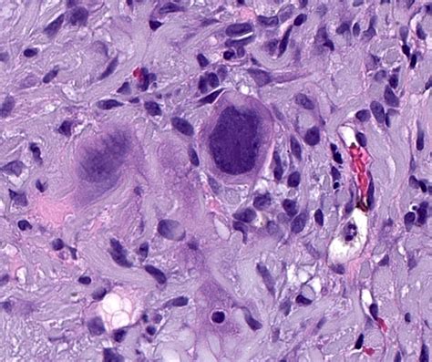 Pathology Outlines Squamous Cell Carcinoma