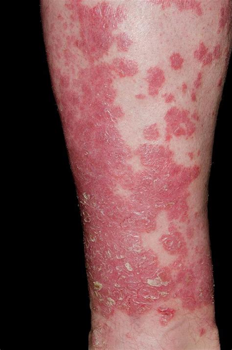 Psoriasis On The Leg Photograph By Dr P Marazzi Science Photo Library