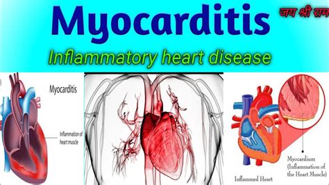 Myocarditis Layers Of Heart Infection And Inflammation Of Heart