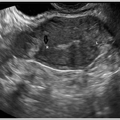 Ultrasonographic View Of Interstitial Ectopic Pregnancy Reproduced