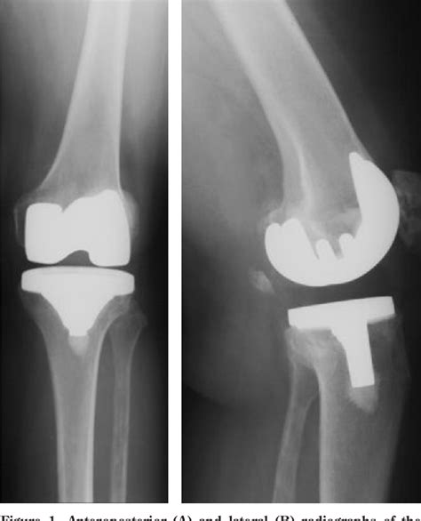 Figure 1 From Posterior Stabilized Versus Posterior Cruciate Ligament