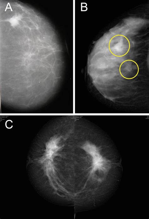 Multifocality Multicentricity And Bilaterality Of Breast Cancer