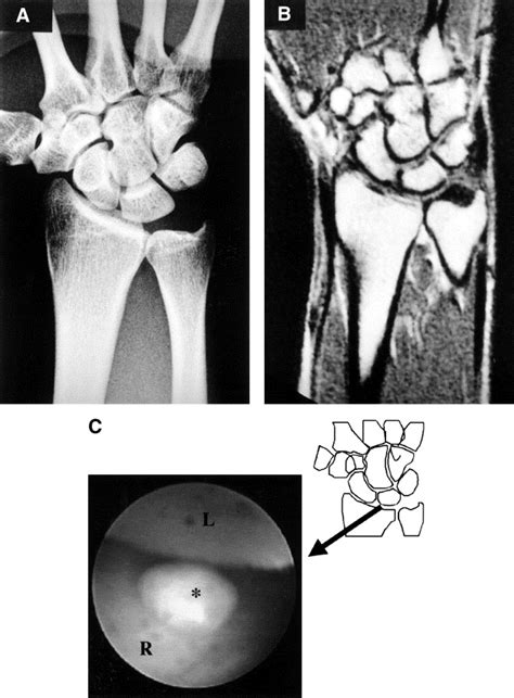 Loose Body In The Wrist Diagnosis And Treatment Arthroscopy