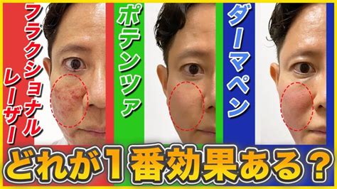 【ニキビ跡毛穴】ダーマペン、ポテンツァ、フラクショナルレーザーで最も効果が高いのは？ お知らせ はなふさ皮膚科・美容皮膚科 東京