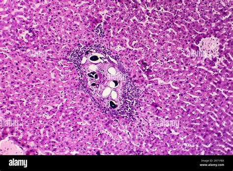 Liver Schistosomiasis Light Micrograph Photo Under Microscope Showing Presence Of Schistosoma