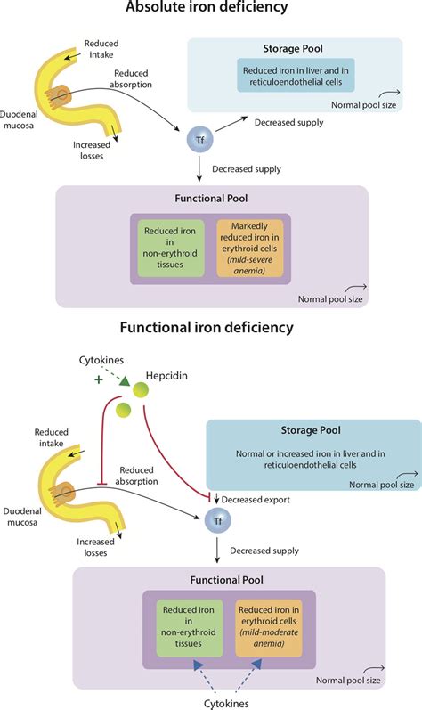 Anemia And Iron Deficiency In Heart Failure Circulation