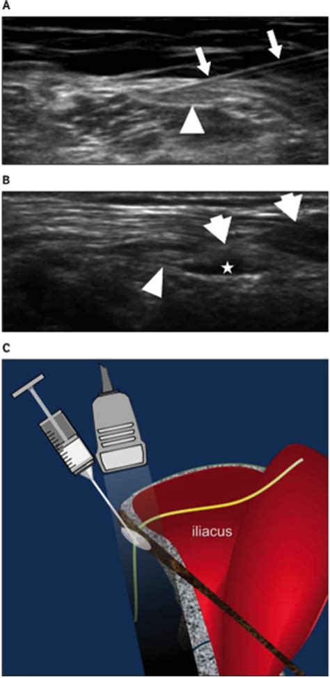 Treatment Of Meralgia Paresthetica Lateral Femoral Cutaneous