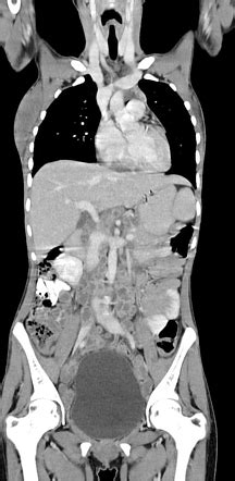 Widespread tuberculous adenitis | Radiology Case | Radiopaedia.org