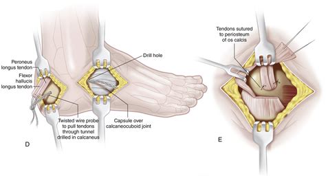 32 Posterior Tendon Transfer to the Os Calcis for Correction of Calcaneus Deformity (Green and ...