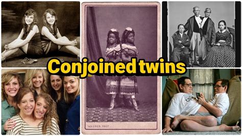 TOP 5 How Five Sets Of Conjoined Twins Navigate Life YouTube