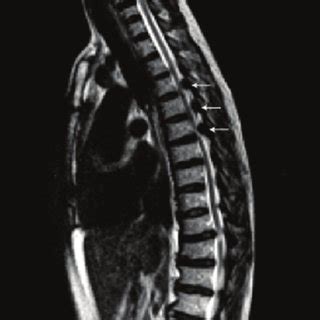 Magnetic Resonance Imaging Of The Thoracic Spine T Weighted Sequence