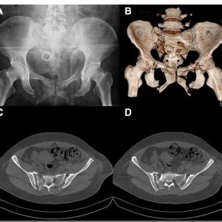 A D AP View And CT 3D Reconstruction Of Pelvic Fracture Showed Type C3