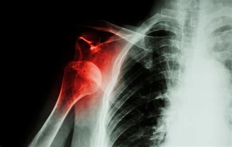 Shoulder Dislocation - A Complete Guide | Dr Mehta, San Jose