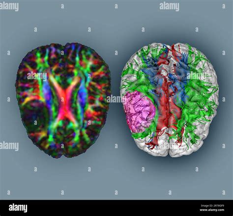 Im Genes Por Resonancia Magn Tica Rm Con Tensor De Difusi N Dti En