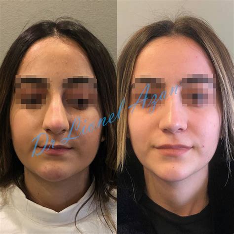 Rhinoplastie Avant Et Apr S Op Ration Paris Institut Rhinoplastie