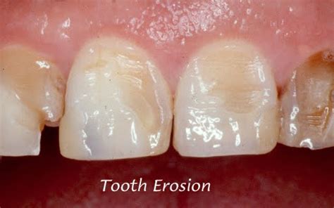 Moore Family Dentistry: Teeth Abrasion and Erosion